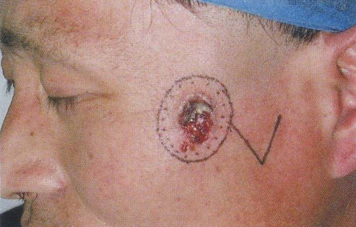 典型病例3改良菱形皮瓣与burow楔形皮瓣联合应用修复左颧部皮肤基底